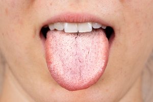 A close-up of a white furry tongue of a girl with a common symptom of a Candida Albicans infection.